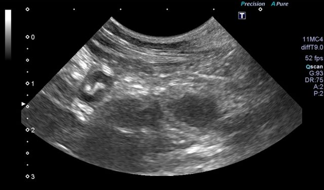 拡張した子宮の超音波画像